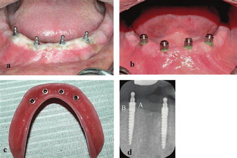 mini implant metal housing|3m mini implants catalog.